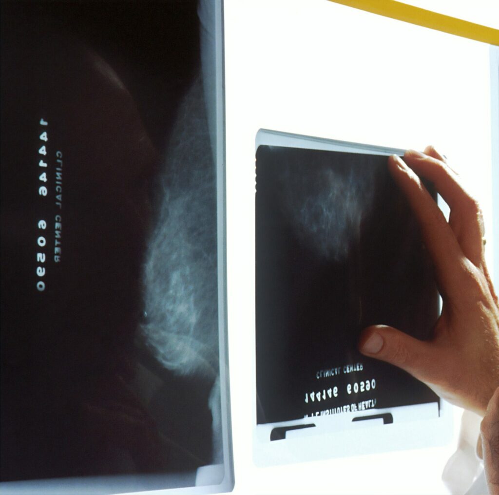 Cliché de mammographie utilisé pour le dépistage du cancer du sein à Marseille.